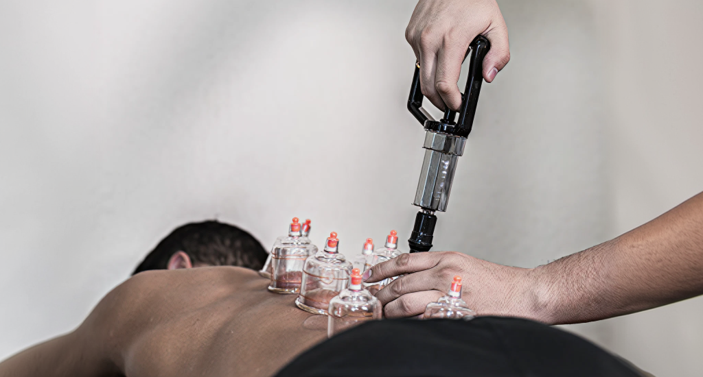 An image of a person lying face down receiving cupping therapy on their back. A practitioner uses a handheld pump to create a vacuum in several clear plastic cups.