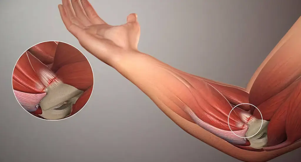 Understanding tendonitis