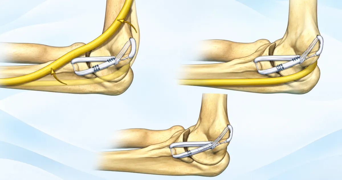 Four-step illustration of how UCL reconstruction surgery is performed